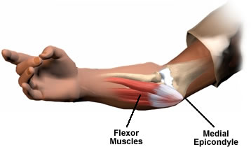 Medial epicondylitis golfers elbow