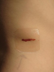 Lump Removed