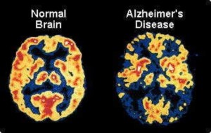 The Cure for Alzheimers Disease