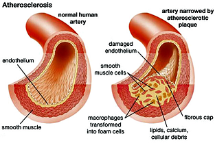 arteriosclerotic calcium plaques